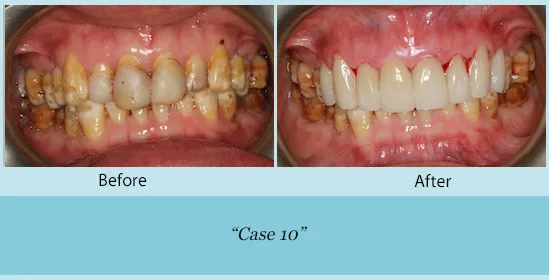 Full Mouth Reconstruction Before and After