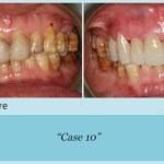 Full Mouth Reconstruction Before and After