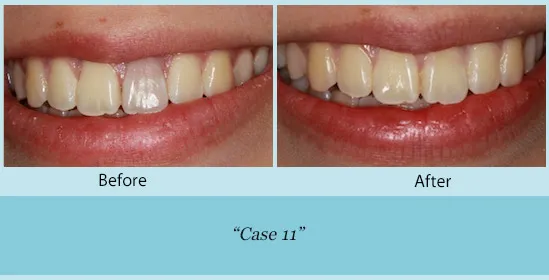 Before and after of teeth shading