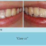 Before and after of teeth shading