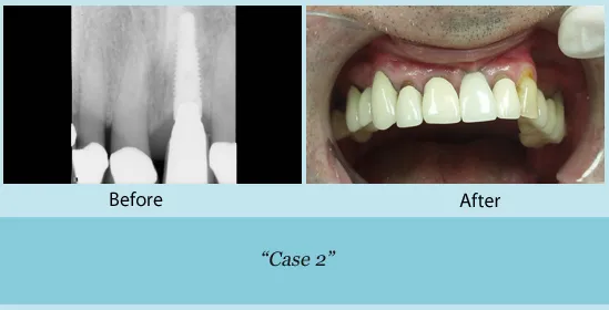Before and after dental implant