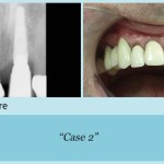 Before and after dental implant