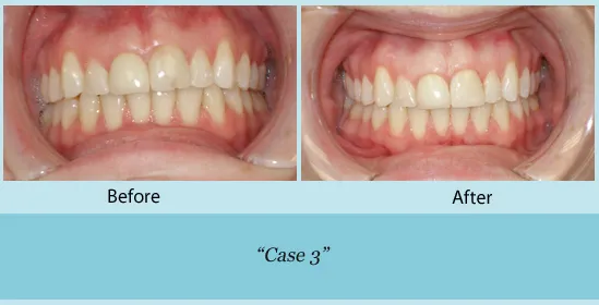 Before and after dental bonding