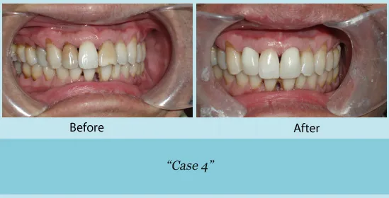 Before and after teeth whitening