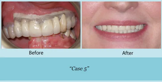 Before and after full mouth reconstruction