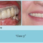 Before and after full mouth reconstruction