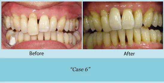 Before and after of teeth straightening 