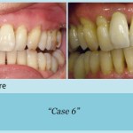 Before and after of teeth straightening 