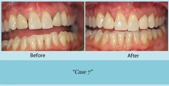 Before and after of dental bonding