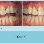 Before and after of dental bonding