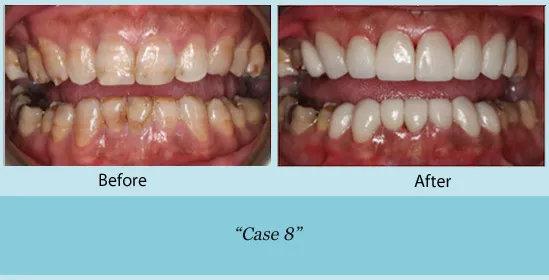 Before and after of teeth cleaning and whitening