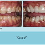 Before and after of teeth cleaning and whitening