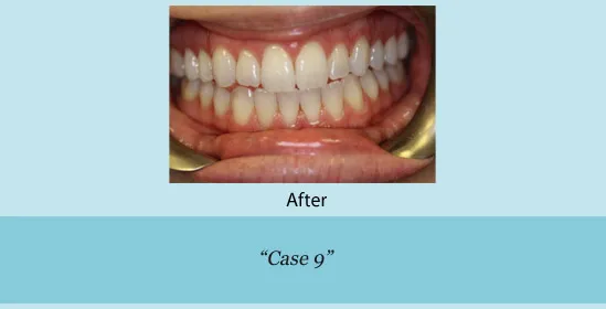 After of teeth cleaning and whitening