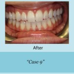 After of teeth cleaning and whitening