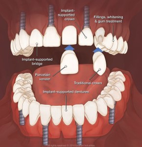 Full mouth reconstruction animation